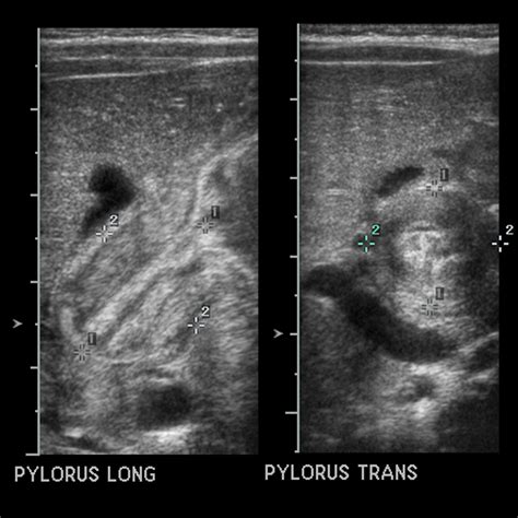 Infant with projectile vomiting | Pediatric Radiology Case | Pediatric ...