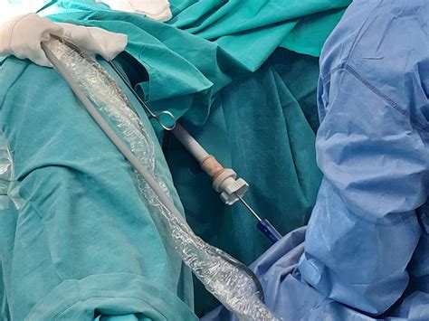 ¿Que es histerectomia total? Te explicamos los diferentes tipos de Histerectomias | Medical Cañada