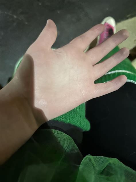 Constant runny nose? : r/Raynauds