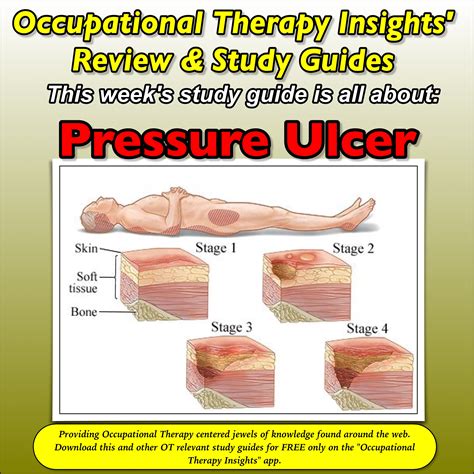 Pressure Ulcer Staging Guide
