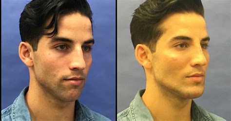 As stigma lifts, more men opt for plastic surgery — from 'torso tucks' to Botox | Hair ...