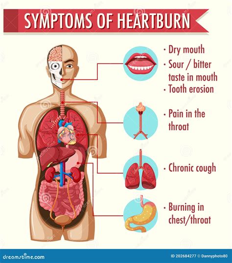 Symptoms Of Signs Of Heartburn at Clara Kilgore blog