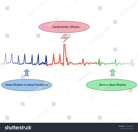 1,912 Electric Shock Heart Images, Stock Photos & Vectors | Shutterstock