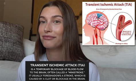 Transient Ischemic Stroke Symptoms