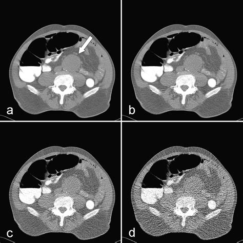 Colon distension and scan protocol for CT-colonography: An overview - European Journal of Radiology