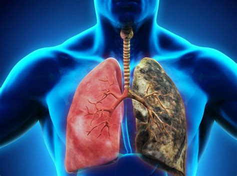 Management of Interstitial Lung Disease