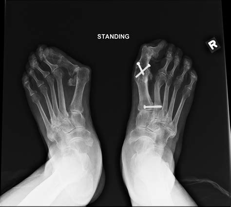 Arthroscopic Arthrodesis of the First Metatarsophalangeal Joint in ...