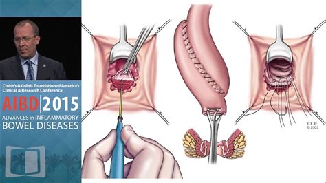 Image result for pouchoscopy