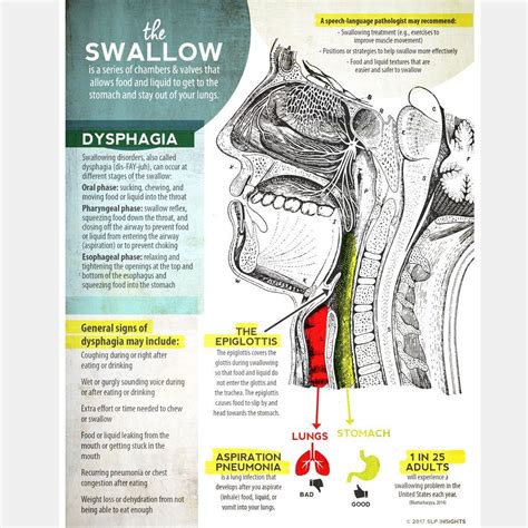 This dysphagia handout provides a quick, simple visual guide to the ...