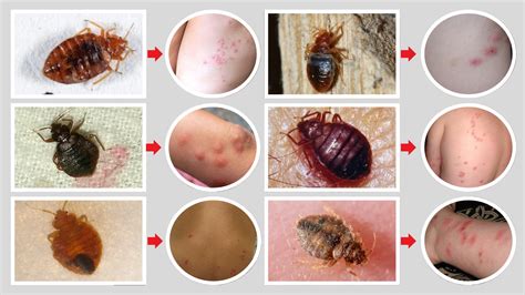Image result for Bug Bite Identification Chart