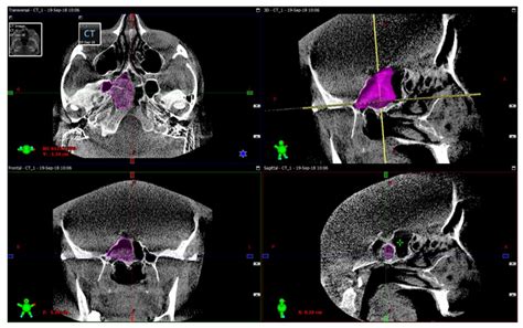 Intraoperative Sphenoid Sinus Volume Measurement as an Alternative ...