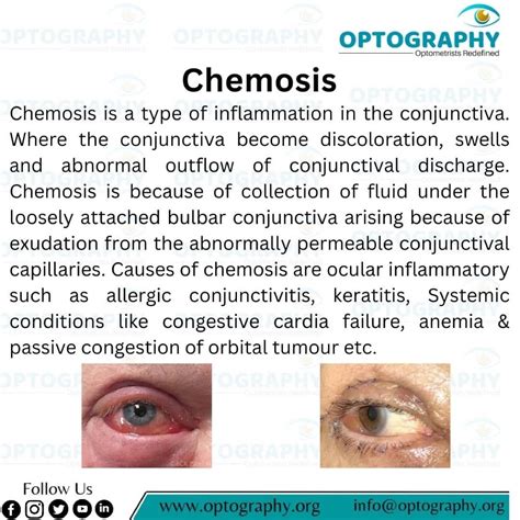 Chemosis: swelling of eye membranes | OPTOGRAPHY posted on the topic | LinkedIn