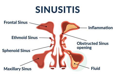 Sinus Disease | Sinus Infection | Premier Allergy, Asthma & Sinus Care