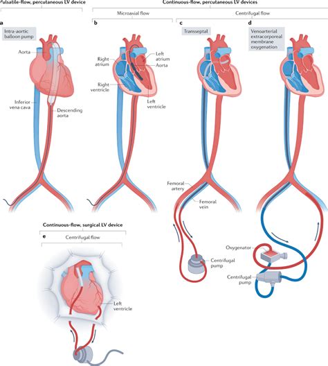 #NephMadness 2023: Heart Failure Devices Region – AJKD Blog