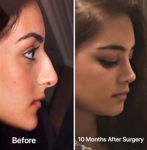 Pin by Medipars on Rhinoplasty before after 2020 | Nose job, Nose plastic surgery, Perfect nose