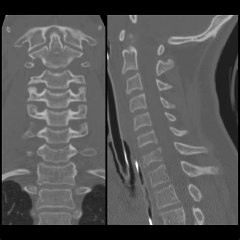 cervical spine fractures | pacs