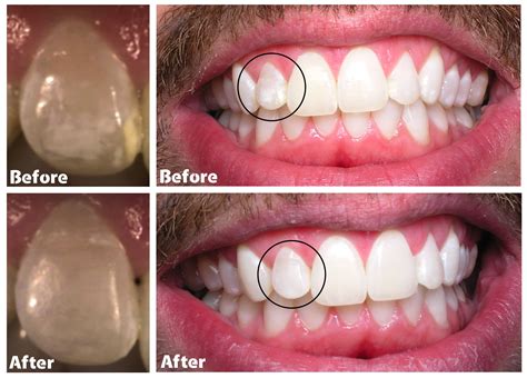 White spots on teeth: causes, treatments, and prevention, teeth whitening spots – PBFF
