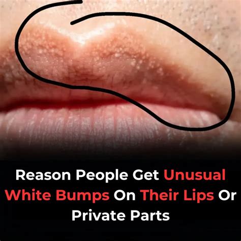 Why You Might See Unusual White Bumps On Your Lips Or Genitals