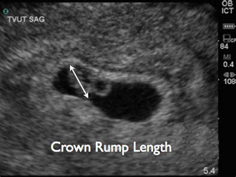 Crown rump length, crown rump length measurement & crown rump length for gestational age