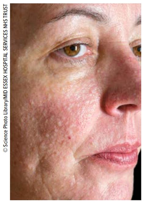 Blickdiagnosen seltener Lungenerkrankungen - Pneumologie - Universimed ...