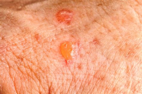Pictures of Actinic Keratosis, Moles, Nevus, and Psoriasis