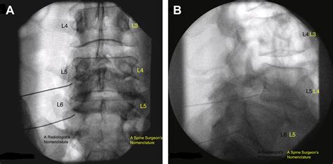 Lumbosacral Transitional Segments - Physical Medicine and ...