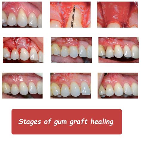 Stages of gum graft healing - Dr Haroon Dental Specialist Clinic Hayatabad Peshawar