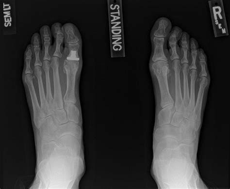 Image result for Toe Surgery