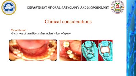 Permanent mandibular first molar | PPTX