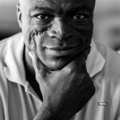 Handsome pop star, Seal suffers from a condition that affects the face ...