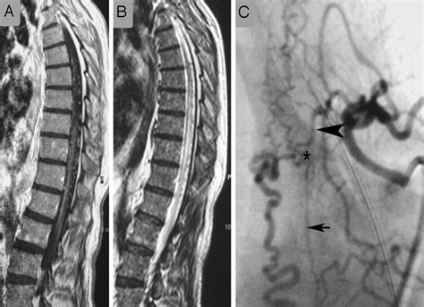 Spinal Dural Arteriovenous Fistulas | American Journal of Neuroradiology