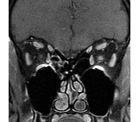 diverticulitis x ray images