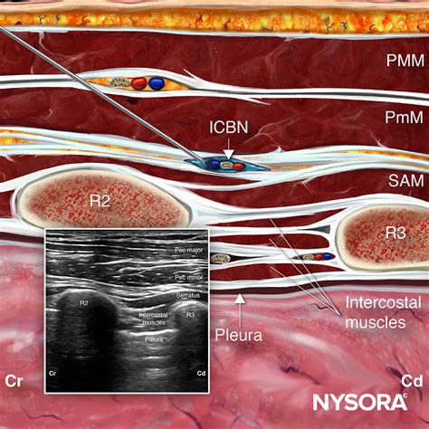 NYSORA Nerve Blocks App - NYSORA