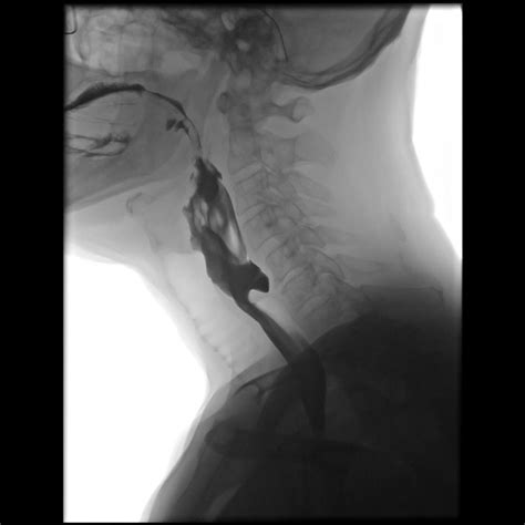 Zenker's diverticulum x ray - wikidoc