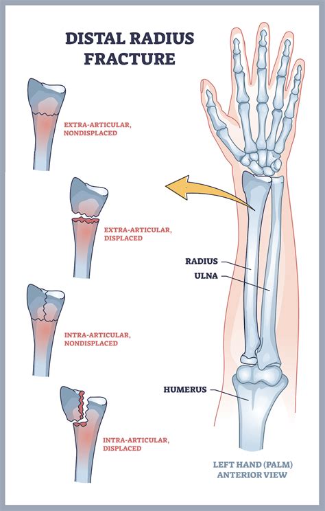 Scaphoid Fracture Vs Wrist Sprain at Douglas Jacobson blog