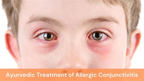 Allergic Conjunctivitis - Causes, Symptoms and Ayurvedic Treatment