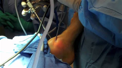 Ankle Arthroscopy - YouTube