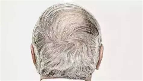 前额长白发的根源到底在哪里？分享治疗白发的方法超简单 - 知乎