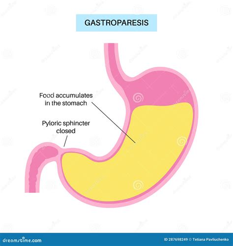 Gastroparesis Anatomical Poster Vector Illustration | CartoonDealer.com #287086960