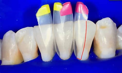 Image result for Bioclear Matrix System