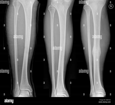 Bone fracture healing hi-res stock photography and images - Alamy