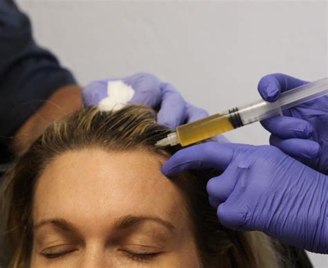 Platelet Rich Plasma for Hair Loss?