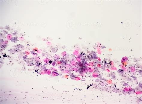 Paps smear analysis, Superficial squamous cell, metaplastic squamous ...