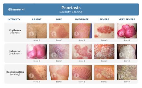 neck psoriasis