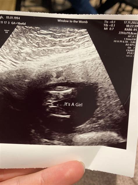 How accurate is 17 week gender scan? | BabyCenter