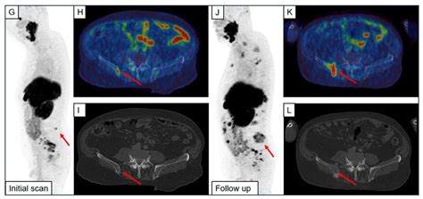 Focal Unspecific Bone Uptake on [18F]PSMA-1007 PET: Evaluation Analog ...