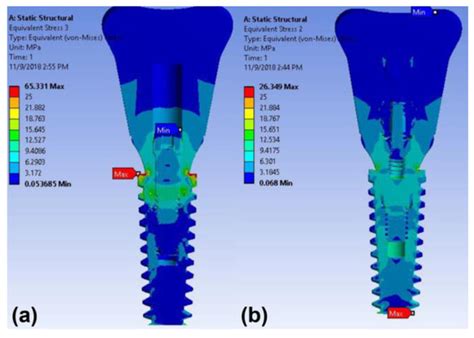 Finite Element Analysis of Dental Implants with Zirconia Crown ...