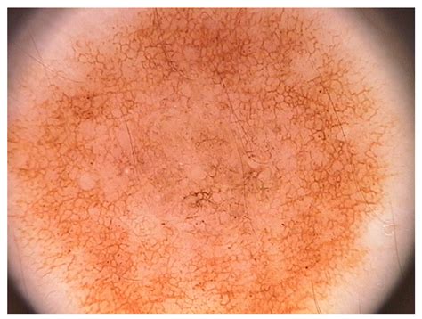 Bio-Inspired Deep-CNN Pipeline for Skin Cancer Early Diagnosis