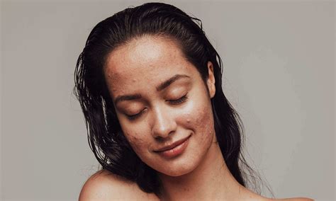 How to Treat Forehead Acne (and Prevent It From Coming Back) | Software