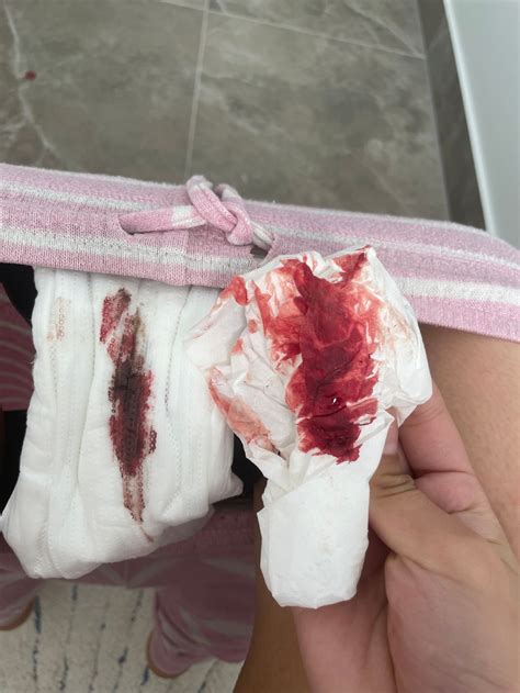 Plan B Made Me Bleed For 2 Weeks Hotsell | emergencydentistry.com